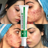 1pcs Herbal Acne Removal Cream Whitening Moisturizing Shrink Pores Oil Control Pimples Acne Treatment Gel Skin Care Face Cream