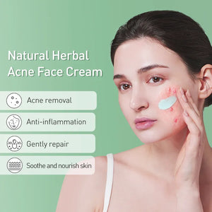 JoyPretty Acne Face Cream Herbal Pimple Scar Removal Shrink Pore Oil Control Moisturizing Facial Cream Acne Treatment Skin Care