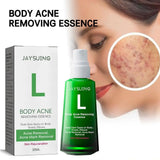 30ml Acne Remover Face Serum Herbs Acne Treatment Pimple Remover Shrink Pores Oil Control Face Herb Acne Skin Care