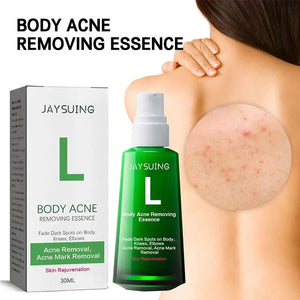 30ml Acne Remover Face Serum Herbs Acne Treatment Pimple Remover Shrink Pores Oil Control Face Herb Acne Skin Care