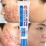 New Powerful Acne Removal Face Cream Clears Pimple Scar Black Dots Gel Treat Severe Acne Shrink Pore Whiten Skin Care Ointment