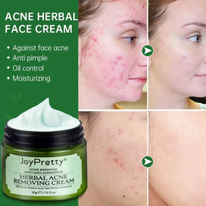 JoyPretty Acne Face Cream Herbal Pimple Scar Removal Shrink Pore Oil Control Moisturizing Facial Cream Acne Treatment Skin Care